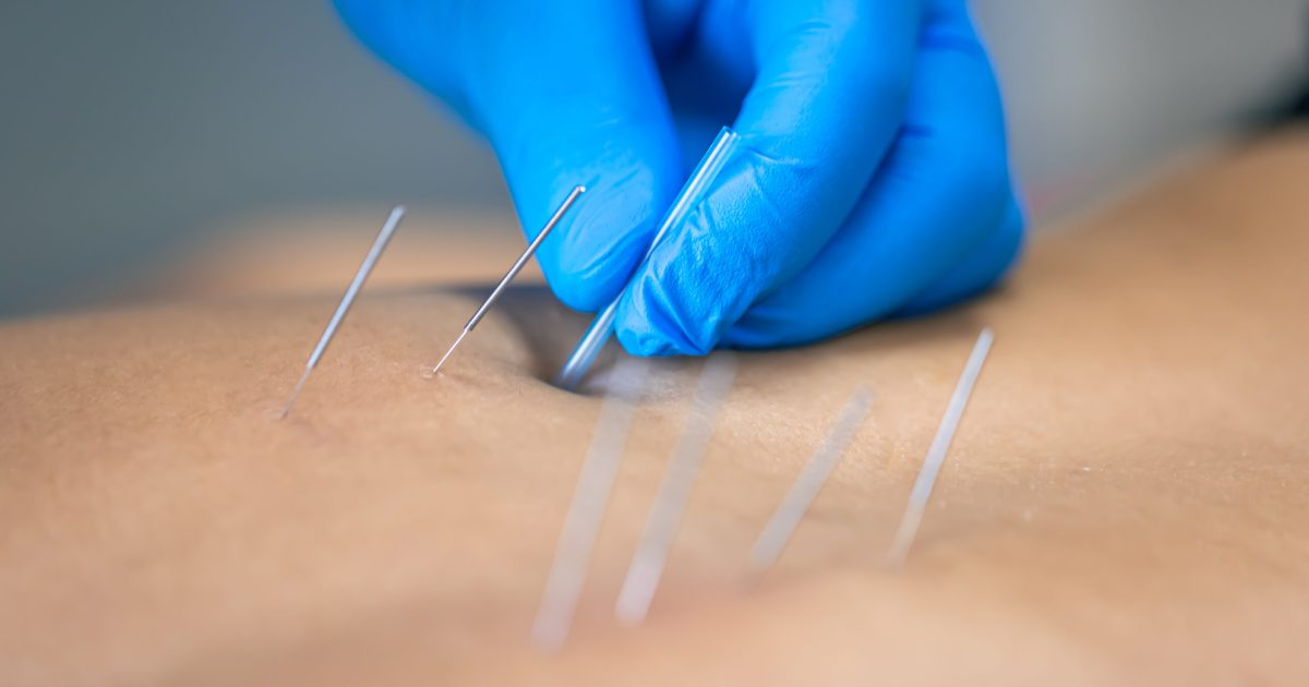 Acupuntura